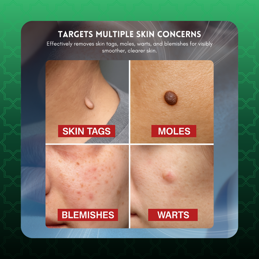 Skin tag Remover Pen [VIP